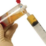 Platelet Rich Plasma injections Indianapolis Dr Barry Eppley