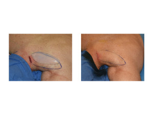 Trapezius Muscle Implants surgical technique 2 Dr Barry Eppley Indianapolis