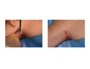 Triceps Implants Incision Closure Dr Barry Eppley Indianapolis