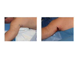 Triceps Implants Incision Dr Barry Eppley Indianapolis