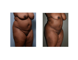 african-american abdominal liposuction result oblique view Dr Barry Eppley Indianapolis