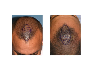 anterior sagittal skull reduction markings dr barry eppley indianapolis