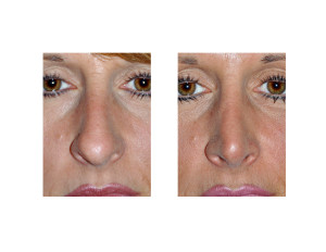 Cephalic Trim Rhinoplasty result front view Dr Barry Eppley Indianapolis