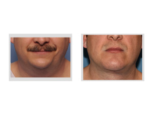 Custom Jawline Implant and Submentoplasty result front view Dr Barry Eppley Indianapolis