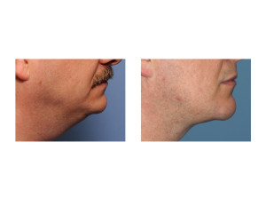 Custom Jawline Implant and Submentoplasty result side view Dr Barry Eppley Indianapolis