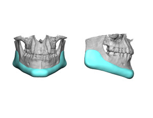 Custom Jawline Implant design Dr Barry Eppley Indianapolis