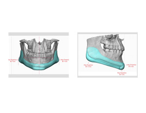 Custom Jawline Implant dimensions Dr Barry Eppley Indianapolis