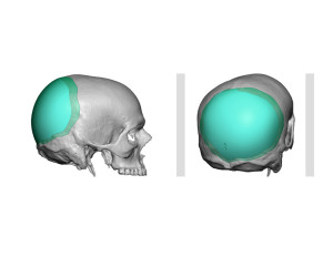 Custom Occipital Implant design for asymmetry Dr Barry Eppley Indianapolis