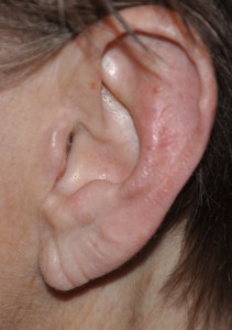 Earlobe Aging Dr Barry Eppley Indianapolis