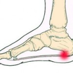 Foot Fat Grafting for Chronic Pain