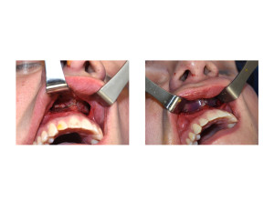 Paranasal Implant Placement Dr Barry Eppley Indianapolis