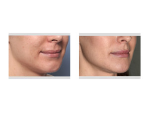 Perioral Mound Liposuction result oblique view Dr Barry Eppley Indianapolis