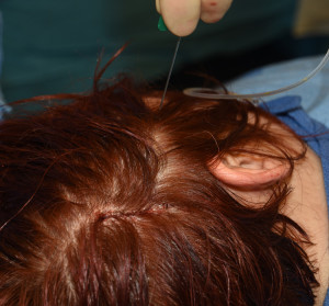 Port Location for Scalp Tissue Expander Dr Barry Eppley Indianapolis