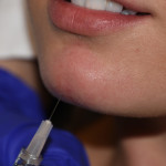 Saline Injection Test for Chin Dimples Dr Barry Eppley Indianapolis