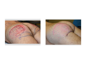 Ultimate Buttock Makeover intraop left oblique view