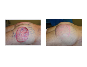 Ultimate Buttock Makeover intraop left side view