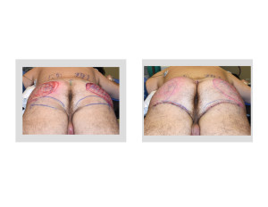 Ultimate Buttock Makeover intraop result back view Dr Barry Eppley Indianapolis