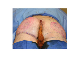 Ultimate Buttock Makeover intraop result one side