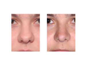 Wide Nasal Tip Rhinoplasty result Dr Barry Eppley Indianapolis