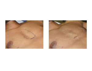 Custom Sternal Implant result intraop oblique view