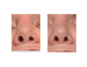 Diced Rib Graft Rhinoplasty result submental view Dr Barry Eppley Indianapolis