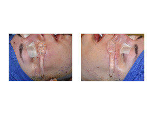 Extended Cheek Zygomatic Arch Implants intraop placement Dr Barry Eppley Indianapolis