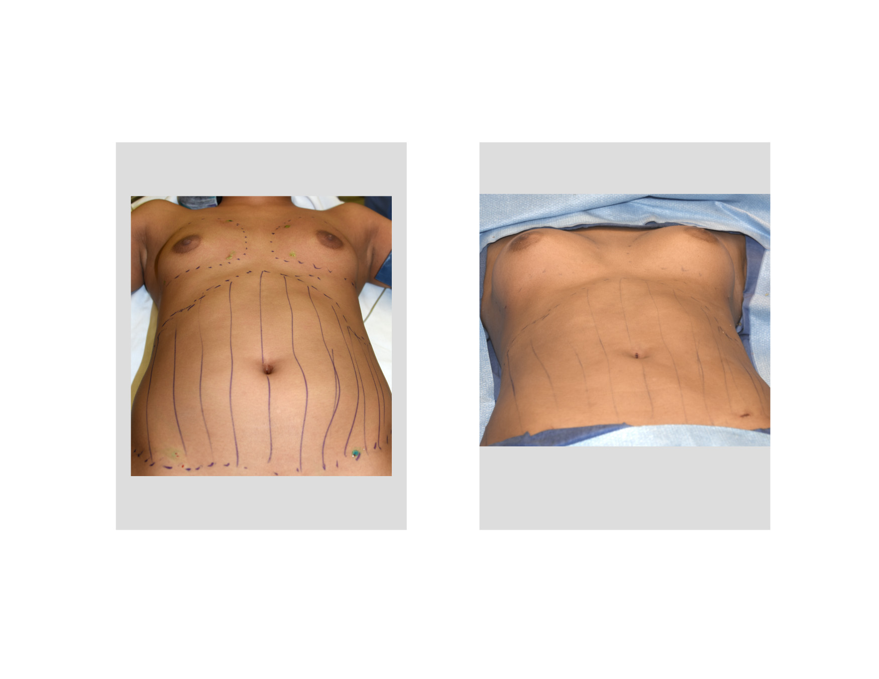 Plastic Surgery Case Study Fat Injection Breast Augmentation