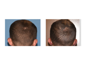 Head Width Temporal Reduction early results back view