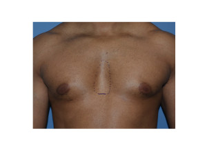 Sternal Defect (minor pectus excavatum)