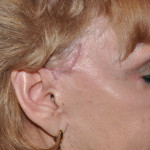 Temporal Cheek Lift Incision Dr Barry Eppley Indianapolis