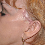 Temporal Cheek Lift Scars Dr. Barry Eppley Indianapolis