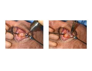 Transpalpebral Browlift drill hole and endotine device Dr Barry Eppley Indianapolis