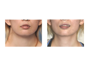Webbed Neck Surgery results Dr Barry Eppley Indianapolis
