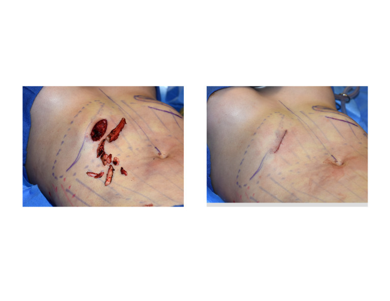 Plastic Surgery Case Study - Subcostal Rib Removals for Vertical