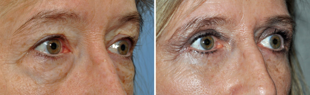 Midface Lift Through A Lower Blepharoplasty Approach - Explore Plastic ...