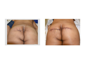 Buttock Reconstruction with Dermal Fat Grafts back view Dr Barry Eppley Indianapolis