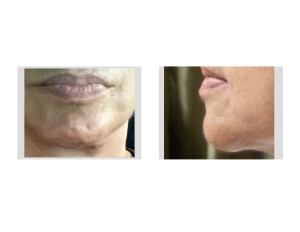 Chin Implant Malposition