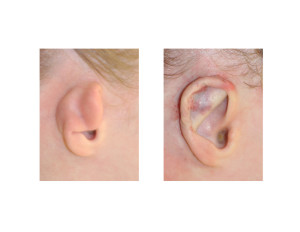 Constricted Ear Reconstruction with Rib Grarft Dr Barry Eppley Indianapolis