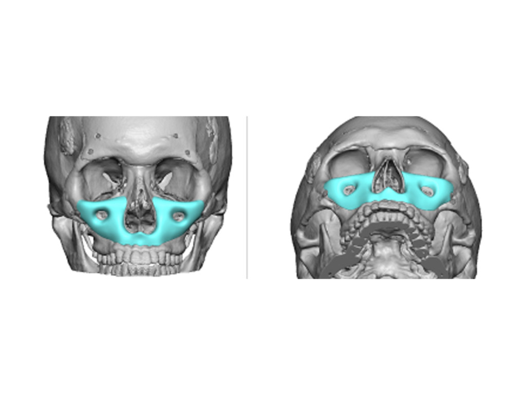 The Custom Midface Implant for Increased Midface Projection Explore