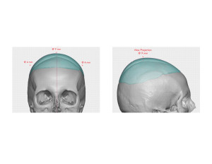 Custom Skull Implant Dr Barry Eppley Indianapolis