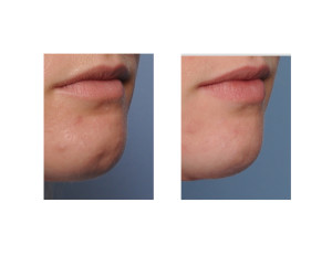 Fat Injections to Chin Dimple result oblique view Dr Barry Eppley Indianapolis