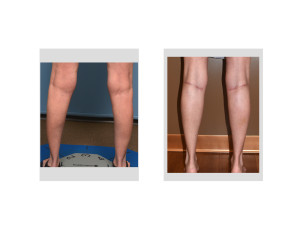 Female Calf Augmentation result back view Dr Barry Eppley Indianapolis