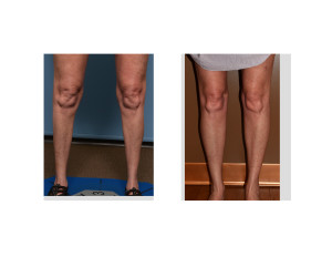 Female Calf Augmentation result front Dr Barry Eppley Indianapolis view