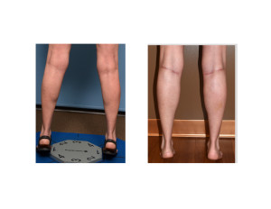 Female Calf Augmentation result raised back view Dr Barry Eppley Indianapolis