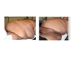 Large Abdominal Panniculectomy intraop result left oblique view Dr Barry Eppley Indianapolis