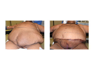 Large Abdominal Panniculectomy result intraop Dr Barry Eppley Indianapolis