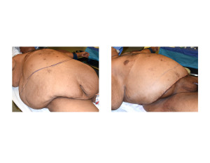 Large Abdominal Panniculectomy result intraop right oblique view Dr Barry Eppley Indianapolis