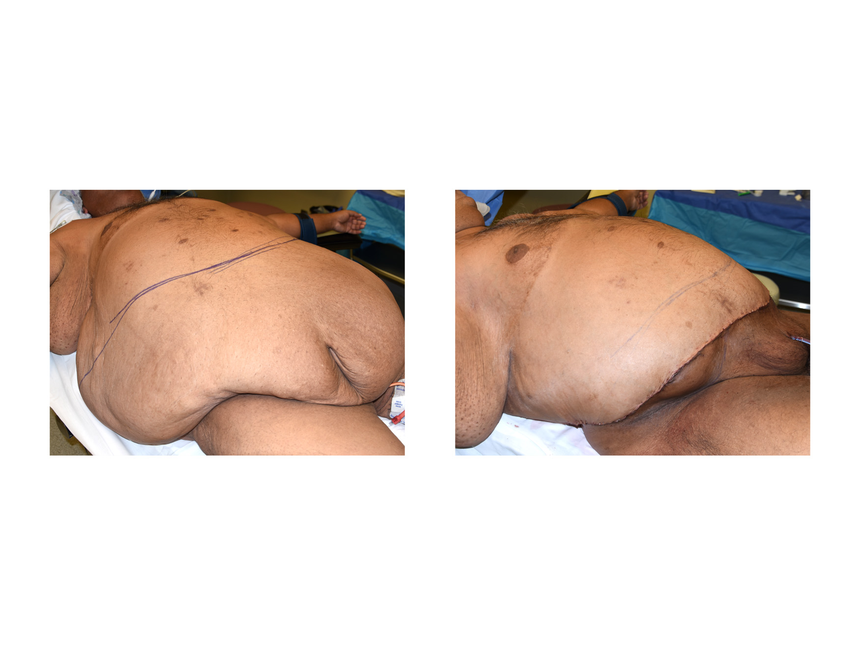 Plastic Surgery Case Study - Large Abdominal Panniculectomy in a