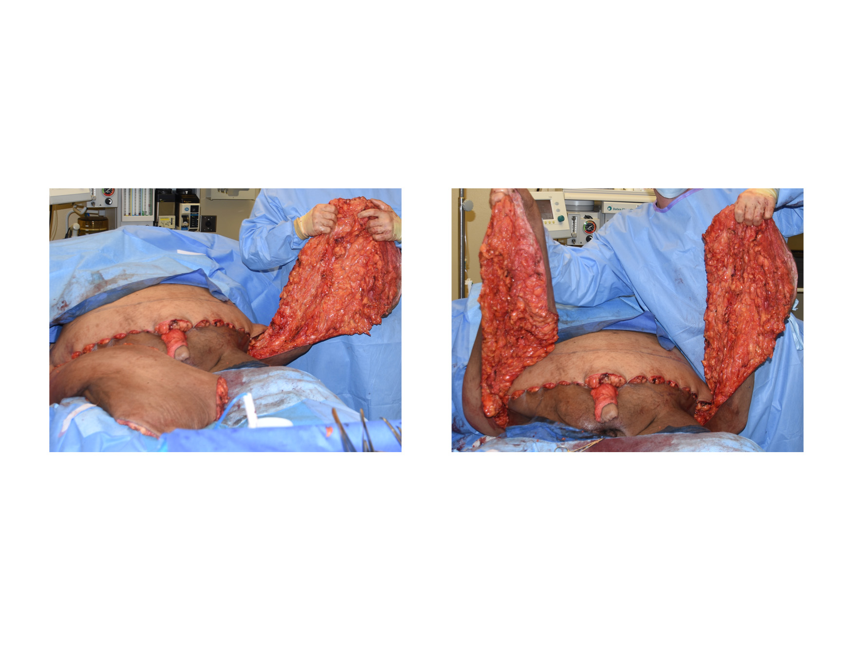 Case Study: Tummy Tuck for the Clefted Abdominal Pannus in a