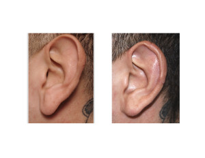 Left Vertical Ear Reduction result (Macrotia Surgery) Dr Barryt Eppley Indianapolis